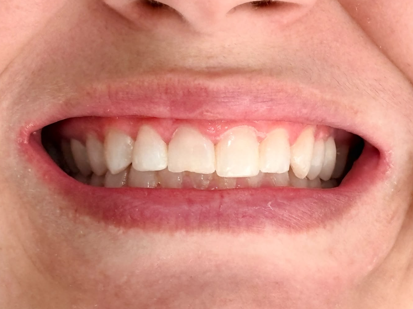 Sorriso, registro antes